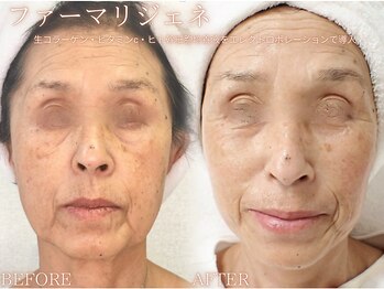 レイネ(REINE)/ファーマリジェネ*フェイシャル