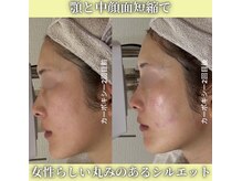 ハニエル(Haniel)/カーボキシー症例