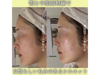 ハニエル(Haniel)/カーボキシー症例