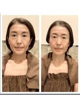 アクア エステティコ 亀有(ACQUA estetico)/シリカニドルピーリング　5回