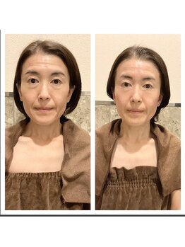 アクア エステティコ 亀有(ACQUA estetico)/シリカニドルピーリング 5回