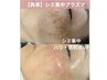 【再来・2回目まで】シミ・くすみ集中プラズマケア★￥22,000→￥15,900