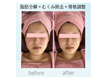 即日効果→3ヶ月集中6回コースで小顔再生するトータルケア小顔術