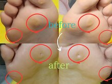 ドクターネイル爪革命 長野店/【たこ・うおのめ】リラク/足裏