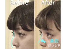 ラプリ 大宮店(Raplit)/隆鼻＋輪郭矯正40分10回