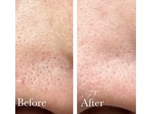 MMK/いちご鼻☆奥までまでゴッソリ