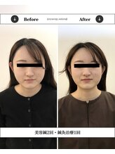 シナジープラス 水前寺店(SYNERGY+)/フェイスラインがスッキリ改善！