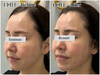 エミマス ボーテ(Emimas Beaute’)/４０代前半　小顔矯正＆毛穴洗浄