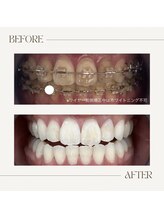 エクシアホワイトニング 津駅前店/スタッフのビフォーアフター