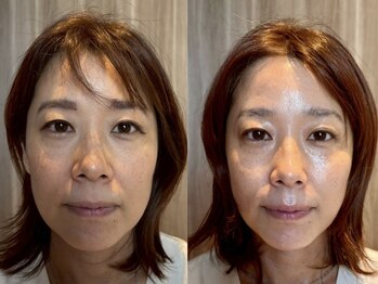 アンティアージュ 福岡本店(antiage)/リフトアップ