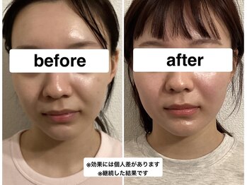 グリーン鍼灸整体院(green鍼灸整体院)/エラ撃退美容鍼