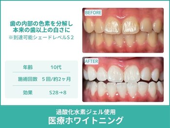 クレア(Crea)/【歯のホワイトニング症例写真】