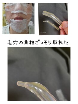 キミーエステティックサロン(kimmy esthetic salon)/小鼻の角栓取れたらスッキリ