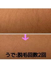 コドモ 所沢店(kodomo)/ビフォーアフター★女性脱毛