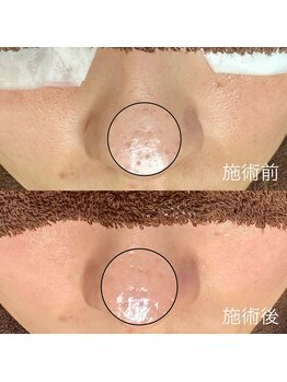 エクラ バイ シャンリィ(eclat by shanLy)/毛穴ケアは早いうちに！