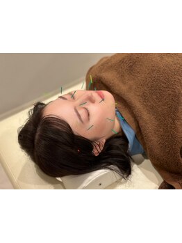 鍼灸施術を受けたい