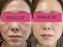 【第1印象120%UP!!全ての肌悩みに】韓国式スキンケアで輝く美肌を手に入れる！話題沸騰ダイヤモンドピール