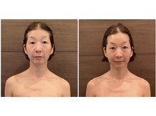 ココ 広島店(COCO)/40代　コルギBeforAfter