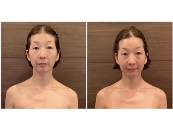 ココ 広島店(COCO)/40代　コルギBeforAfter