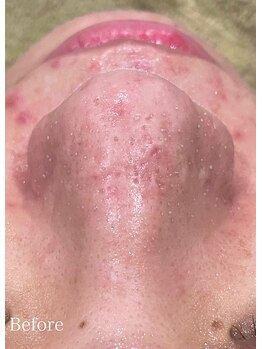 ドクターエイチ 四ツ橋堀江店(Doctor.H)/ハイドロ毛穴洗浄