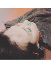 レメディ/美容鍼スペシャルコース