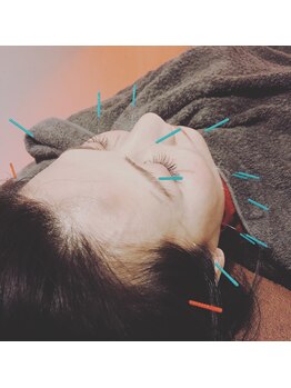 レメディ/美容鍼スペシャルコース