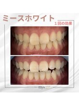 ミースホワイトニング(mys whitening)/ビフォーアフター【歯科提携】