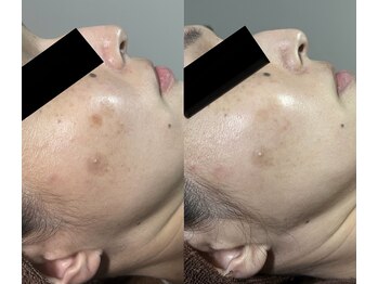 パシテア(Pasithea)/BBLフェイシャル