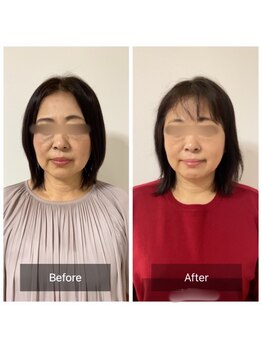 チル(Chill.)/美容整体×小顔整顔で月1ケア☆