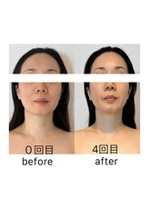 アトリエドゥアージュ(Atelier de age)/光糸[コウシ]リフト