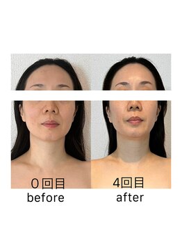 アトリエドゥアージュ(Atelier de age)/光糸[コウシ]リフト