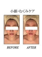 ファミーユ 新宿店/【インディバ小顔・むくみケア】
