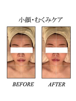 ファミーユ 新宿店/【インディバ小顔・むくみケア】