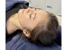 グッドバランス 学芸大学(Good Balance)/【メニュー】　美容鍼