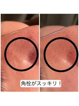 ウイユサロン(oeilsalon)/毛穴集中トリートメント