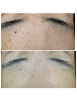 カンナ(Kanna)/艶肌Waxで毛穴レス☆