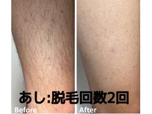 コドモ 所沢店(kodomo)/ビフォーアフター★男性脱毛
