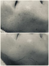 エルール トータルビューティ(Aileure total beauty)/肌質改善　韓流肌