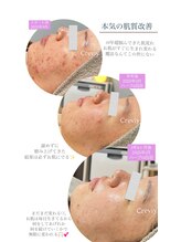 クレヴィー(Creviy)/肌質改善☆ハーブ継続の変化