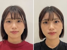 ストリ(STRI)/美容鍼3回施術後