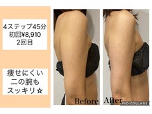 ハピネス(HAPPINESS)/4ステップメニュー　二の腕2回目