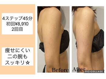 ハピネス(HAPPINESS)/4ステップメニュー　二の腕2回目