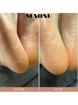 マオヌー(MAONU)/韓国式足裏角質ケア　症例写真