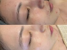 モナートドゥ(Monartdeux)/ハーブピーリング経過