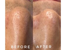 カウニス るる(kaunis)/【ララピール】Before After