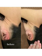 アルティ 福岡大名店(ARTI,)/襟足脱毛