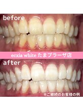 エクシアホワイトニング たまプラーザ店/ビフォーアフター