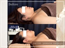 ヤワラ 長与店(yawara)/πテラピーBefore After