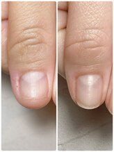 スマイルニコ(smile nico)/深爪矯正　自爪育成