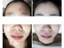 ミュー(Mieux)/肌悩みがなくなりました！　